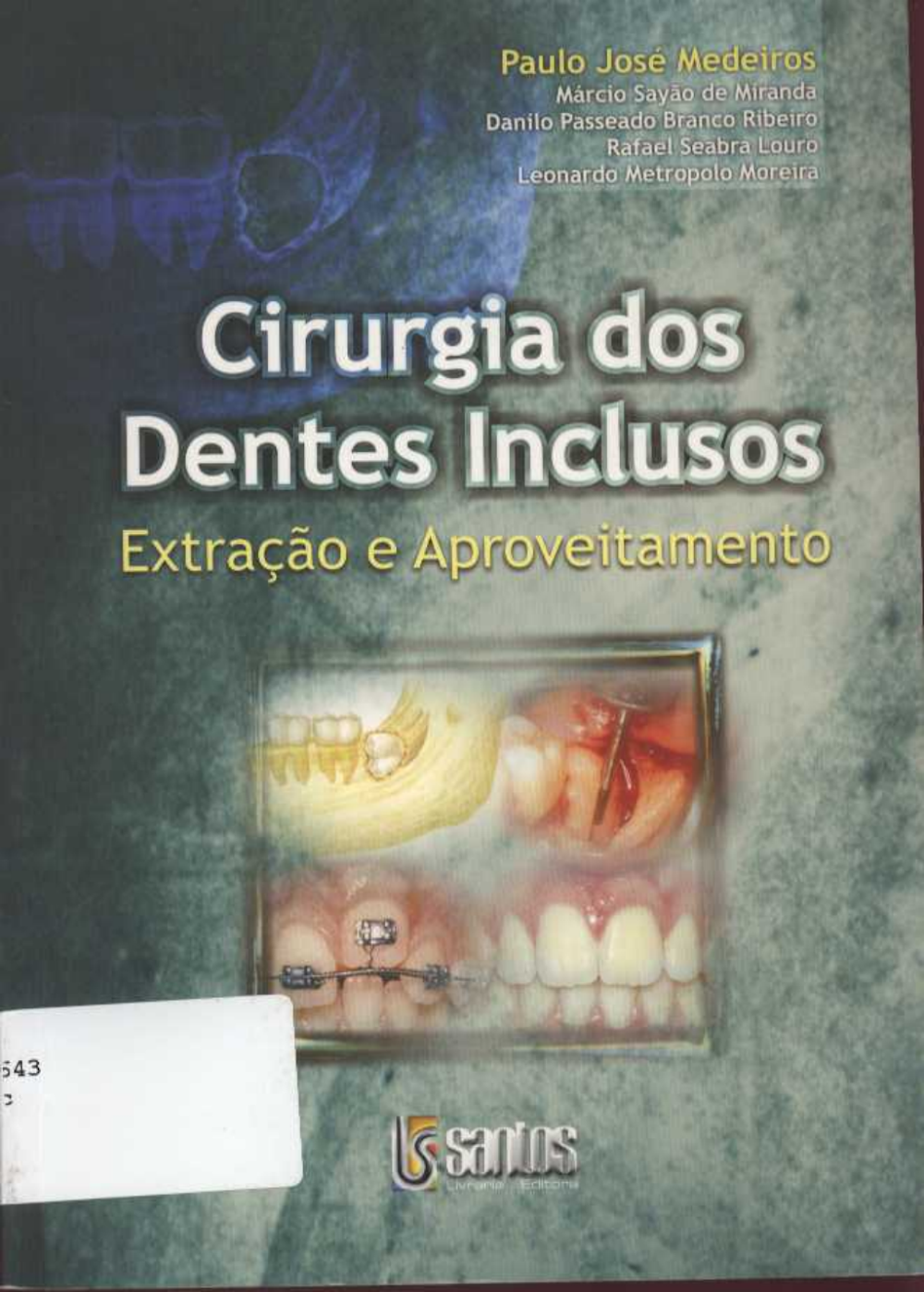 Livro Cirurgia dos Dentes Inclusos: Extração e Aproveitamento