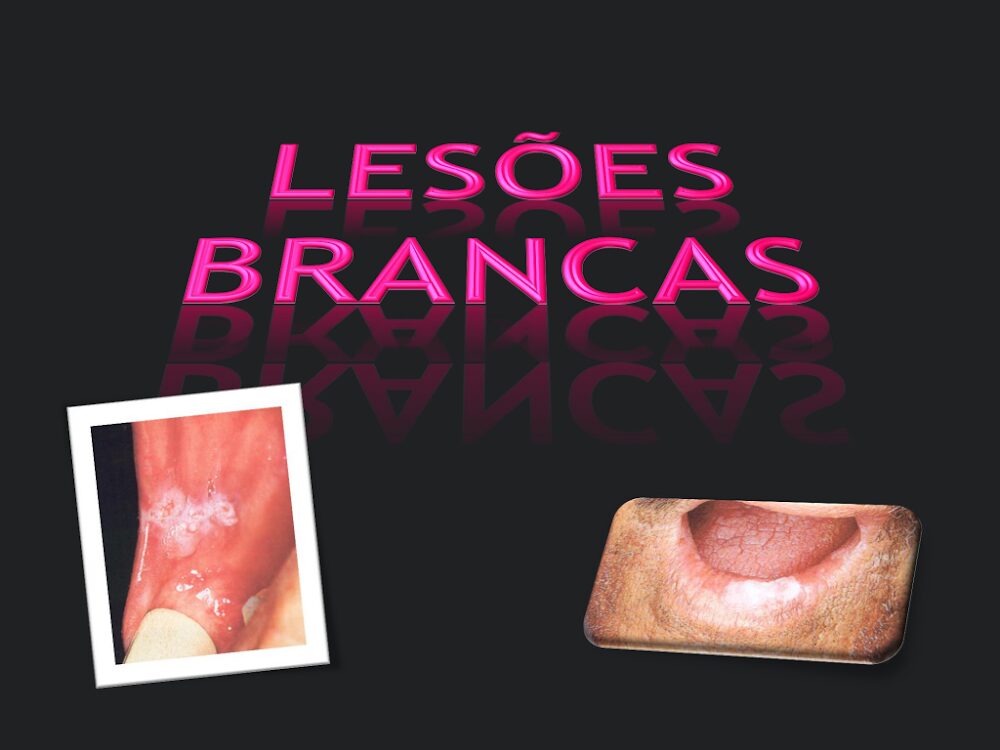 Lesões Brancas Orais: Diagnóstico e Clínica