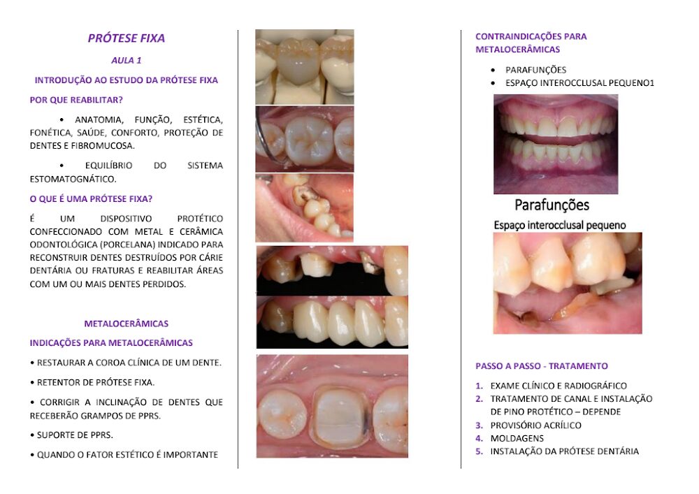 Resumo Completo de Prótese Fixa em Odontologia