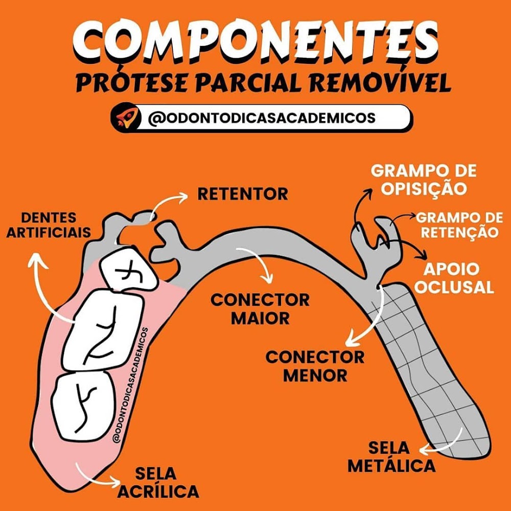 Guia de Componentes da Prótese Parcial Removível (PPR)
