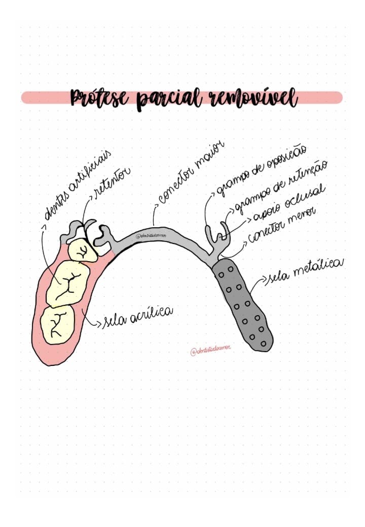 Componentes da Prótese Parcial Removível: Guia de Anatomia