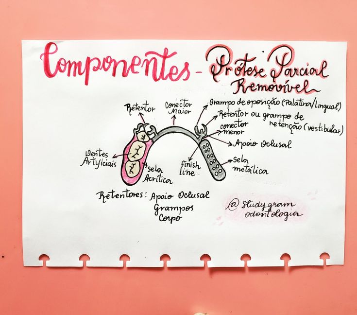Componentes da Prótese Parcial Removível: Guia de Estudo